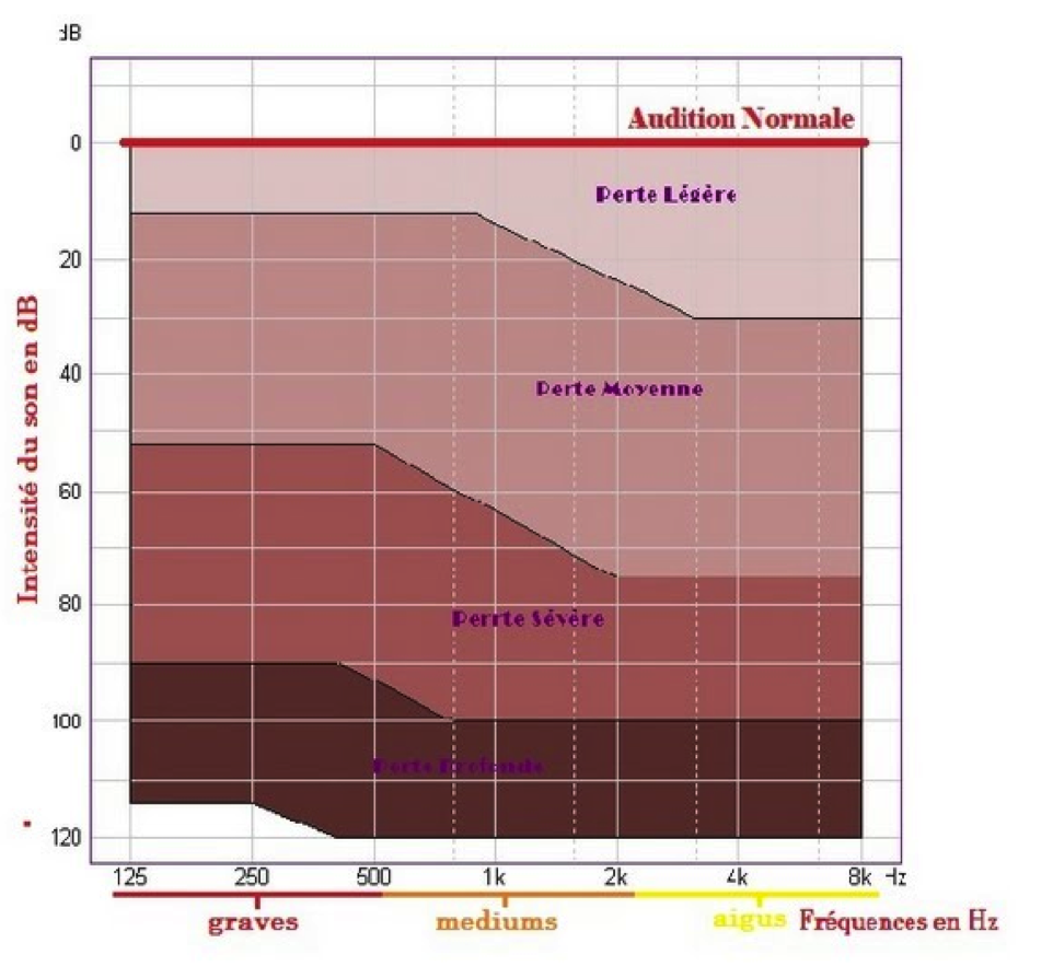 Perte auditive selon les degrés de surdité  